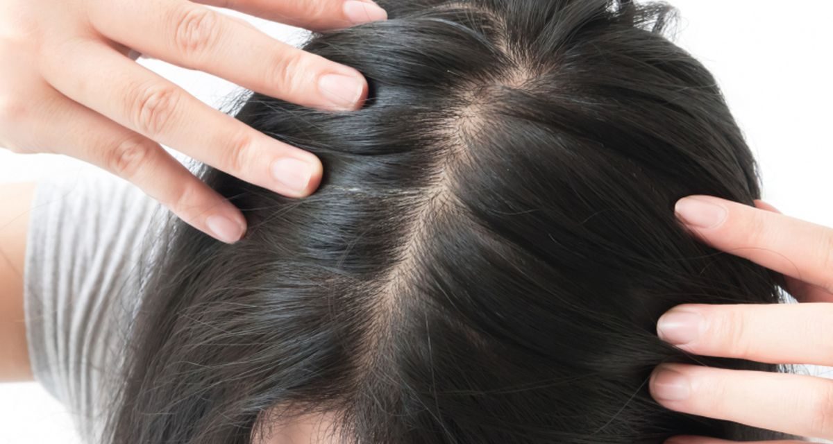 Rambut Menipis Karena Kebiasaan Ini, Jangan Abaikan!