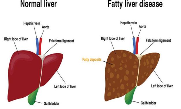 Jangan Anggap Sepele! Ini Daftar Minuman Perusak Hati